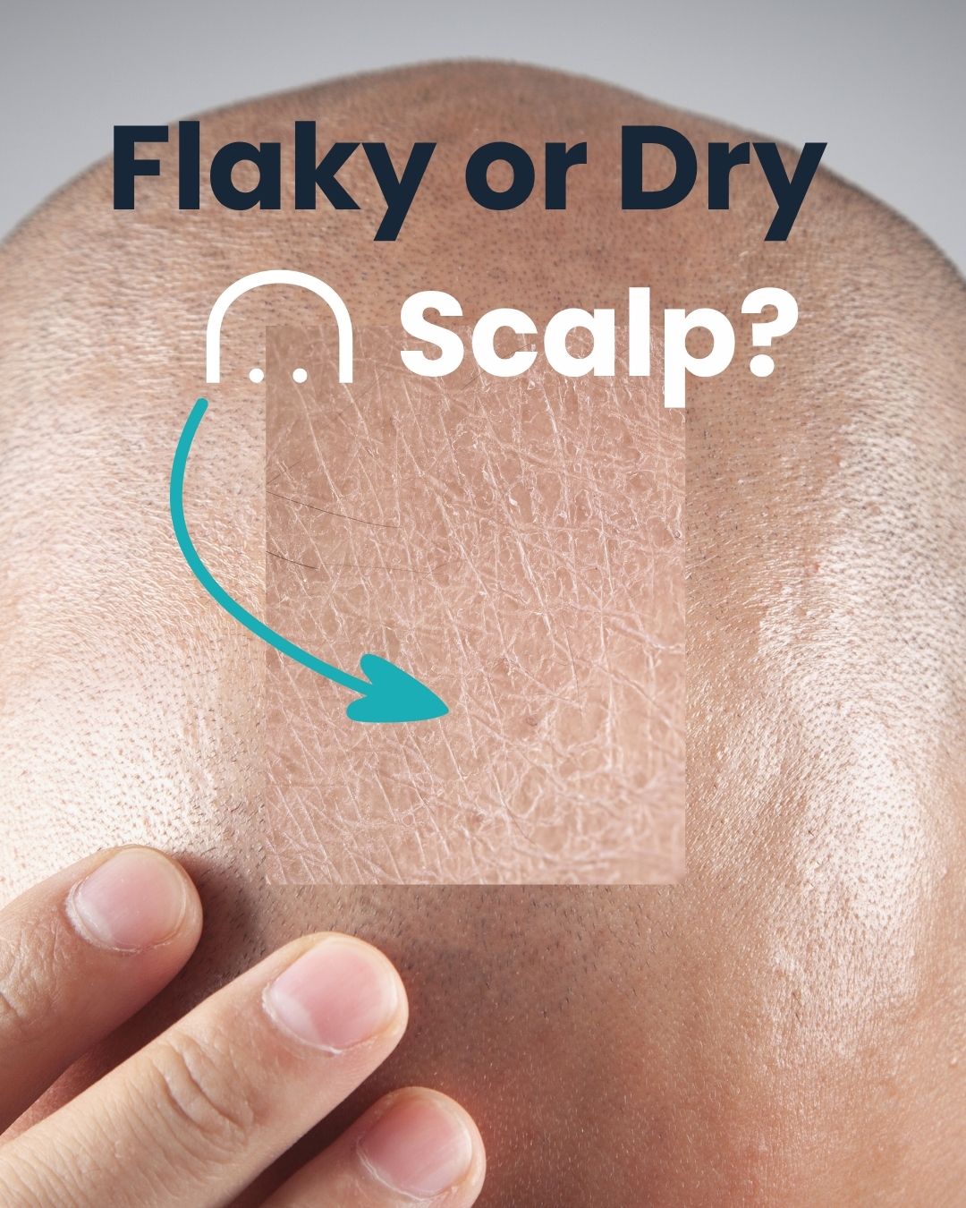 Dry, Flaky Scalp on a Bald Head: Causes, Care & Long-Term Solutions